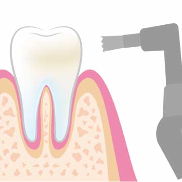 美容歯科クリーニング